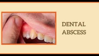 Understanding Dental Abscess Causes Symptoms and Treatment shorts youtubeshorts [upl. by Epotimet]