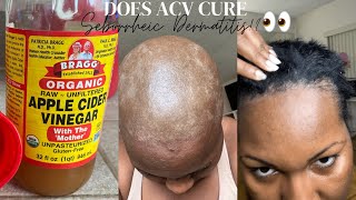 Treating My Seborrheic Dermatitis with ACV RINSE Remedy 🙆🏾😫👀😅 [upl. by Inger949]