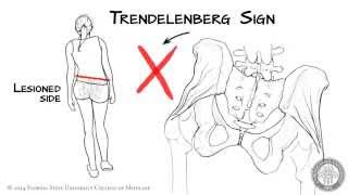 The Trendelenberg Sign HD [upl. by Sheri]