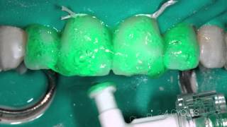 White spot treatment with DMG ICON [upl. by Tess]