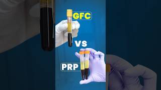 PRP or GFC Hair Transplant Technique hairtransplant hair prp gfc shorts [upl. by Eeslek]