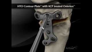 HTO ContourLock HTO Plate with ACP treated OSferion [upl. by Jase]