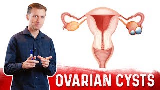 Ovarian Cysts Causes Symptoms amp Natural Treatment – DrBerg [upl. by Eeladnerb]