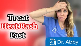 How to identify and treat heat rash fast [upl. by Ixel]