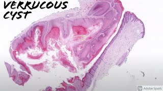 Verrucous Cyst 5Minute Pathology Pearls [upl. by Belter]