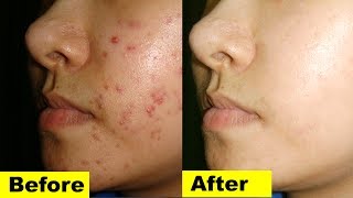 Best Acne Prone Skin Home Remedies Best Acne Treatment at Home by NAHR [upl. by Landsman]