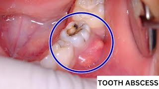 How Do I Know If My Tooth Is Abscessed   How to Identify an Abscessed Tooth  Symptoms and Signs [upl. by Prudhoe771]