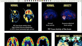 244b PET Scan Working Principle  A2 Medical Physics  Cambridge A Level 9702 Physics [upl. by Muffin]