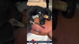 Magnetic Tattoo Removal Ink Extraction [upl. by Adon]