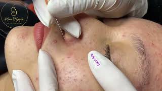 Loan Nguyen Acne Treatment 0794hn [upl. by Soinotna]