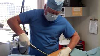 Dr Thomas Barnes LAUGHING THIGHS Tickle Lipo  Part I Newport Beach Ornage County [upl. by Ybocaj]