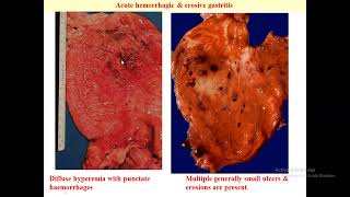 Benign Stomach Pathology 1 [upl. by Eddina]