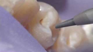 Dental Air Abrasion  Denville NJ [upl. by Kilar]