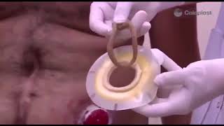 Colostomy bag application Malayalam [upl. by Munafo281]