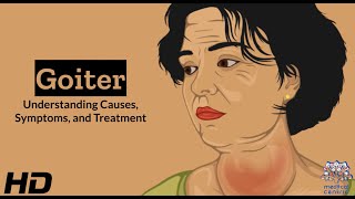 Thyroid Troubles Navigating Goiter  Causes Symptoms and Treatment Explained [upl. by Anal]