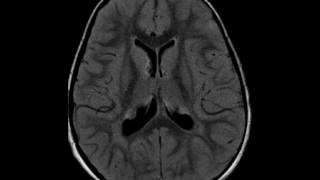 Tuberous Sclerosis [upl. by Iak]