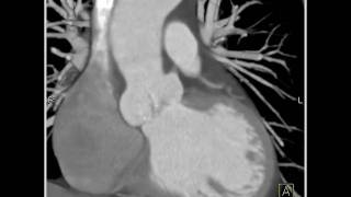 Cardiac Dilated aortic root and sinuses of Valsalva 7 of 10 [upl. by Mahseh]