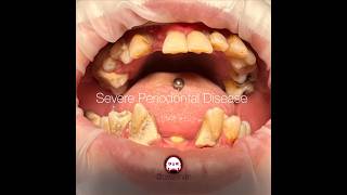 Severe Periodontal Disease with bone loss generalized inflammation and tissue edema [upl. by Edythe]