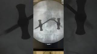 How is Spine vertebroplasty kyphoplasty done  Dr Ajay Kothari  Sancheti Hospital [upl. by Ollie]