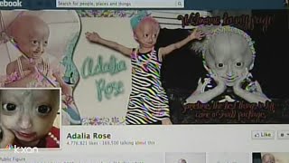 Adalia Rose Austinite social media star with rare genetic condition dies at 15 [upl. by Ellatsirhc949]