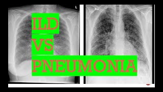 Chest Xray interstitial lung disease vs PneumoniaTypes of opacities in lungs [upl. by Nahtnaoj85]