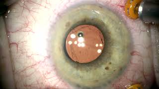 IZHV Iridozonular hyloid vitrectomy and Floaterectomy by Steven G Safran MD [upl. by Bajaj326]