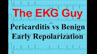 EKGECG  Pericarditis vs Benign Early Repolarization  The EKG Guy  wwwekgmd [upl. by Homovec]