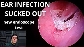 Ear Infection Sucked Out New Endoscope Test [upl. by Allmon]