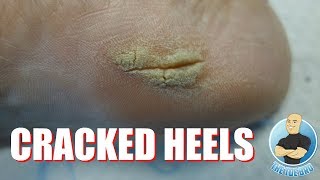 HOW TO GET RID OF CRACKED HEELS  FULL TREATMENT [upl. by Maitund]