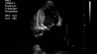 hypertrophic cardiomyopathy and congenital mitral valve perforation [upl. by Rimidalb]