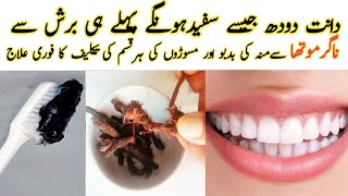 Dant Saaf Karne Ka Tarika Teeth whitning  ناگر موتھاPlaque amp Tartar Removal [upl. by Sirehc]