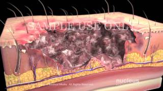 Burns Classification and Treatment [upl. by Sirmons]