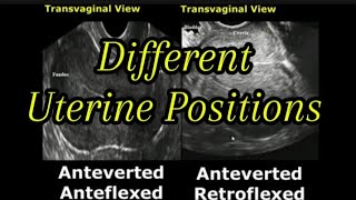 Uterine Positions In Ultrasound  AntevertedRetroverted  AnteflexedRetroflexed Uterus [upl. by Clifton]