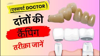 Dental Crown kaise banta hai Dental capping🧢 [upl. by Aicrag]