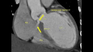 Gerbode defect [upl. by Turley]