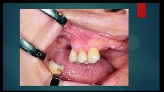 Oral Surgery L1 Preprosthetic Surgery [upl. by Ttirrem]