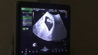 Hearing our baby’s heartbeat 💗 2nd UltrasoundIUI Success [upl. by Arriet989]