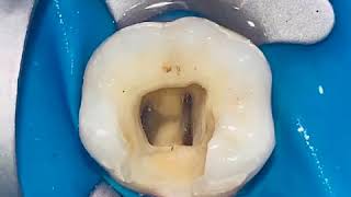 Access Opening of Mandibular First Molar [upl. by Livingston]