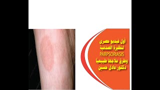 أول فيديو حصرى لنظيرة الصدفية PARAPSORIASIS وطرق علاجها طبيعياً دكتورعادل حسين [upl. by Dehsar]