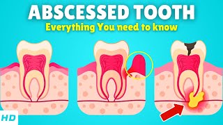 Abscessed Tooth – Causes Signs and Symptoms Diagnosis amp Treatment [upl. by Enelra720]