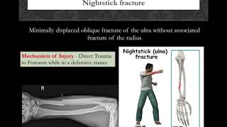 LetsLearnOrthowithDrApurv  Upper limb fractures Eponyms [upl. by Brody]