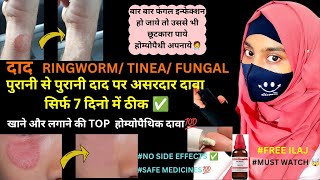 Ringworm fungal infection Tinea causes symptoms tt दाद का इलाज Top Homeopathic medicines doctor [upl. by Karissa]