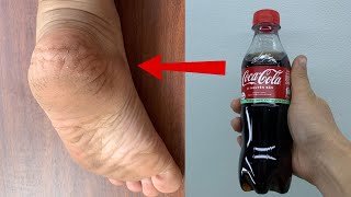 Get Rid of CRACKED HEELS Permanently Magical Cracked Heels Home Remedy [upl. by Ahtelat]