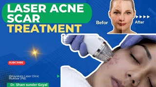 Laser Acne Scar Treatment  CO2 Laser  MNRF  Apollo Duet  Ulthera  IPL  Subcision [upl. by Atnek138]