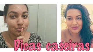 SEGREDO CASEIRO PARA ACABAR COM A SEBORREIA DO ROSTO QUE FUNCIONOU COMIGO  LARISSA CRISTINE [upl. by Jaco]