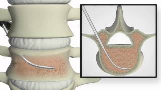 Confidence vertebroplasty [upl. by Ayikal588]