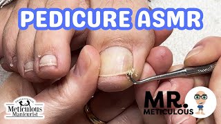 👣ASMR Pedicure Cleaning💆‍♀️ Epic Impacted Toenail Debris Removal on Mr Meticulous👣 [upl. by Standush284]