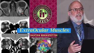 ExtraOcular Muscles  Graves Disease amp Orbital Pseudotumor by Dr Barton Branstetter [upl. by Ssilb504]