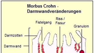 Fisteln bei CED [upl. by Stafani]