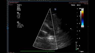 Branch pulmonary artery stenosis critical [upl. by Ninette477]